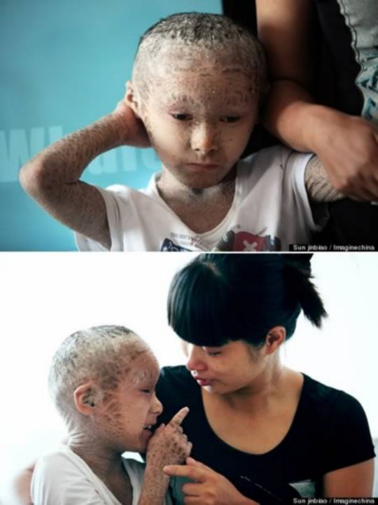 Pan Xianhang - The 8-Year-Old Known as the “ Fish Boy” (Ichtyosis)
