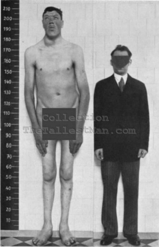Adam Rainer - The Man Who was a Dwarf and Later a Giant (Acromegaly)