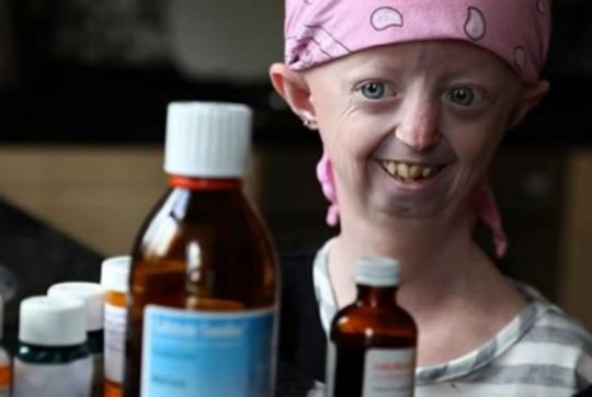 Hayley Okines - The Oldest Looking Teenager (Progeria)