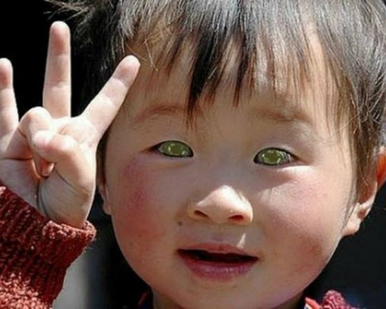 ჩინეთში ცხოვრობს ბავშვი, რომელსაც უნიკალური ფერის თვალები აქვს.