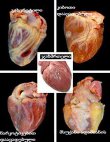 ადამიანის გული სხვადასხვა დაავადებებით